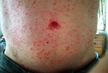 En alerta Sinaloa por la fiebre Mayaro