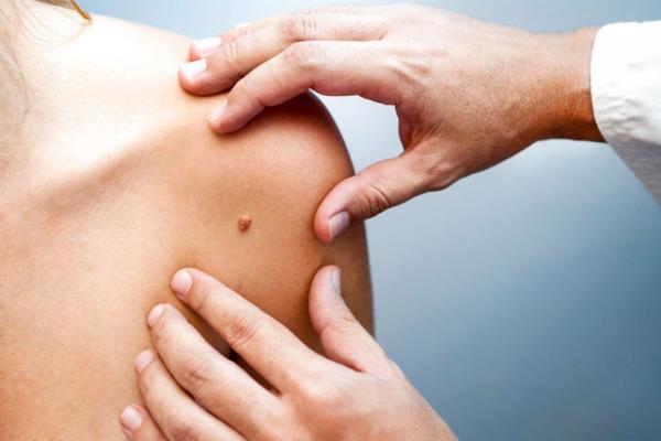 El clima en Sinaloa favorece la incidencia de cáncer de piel