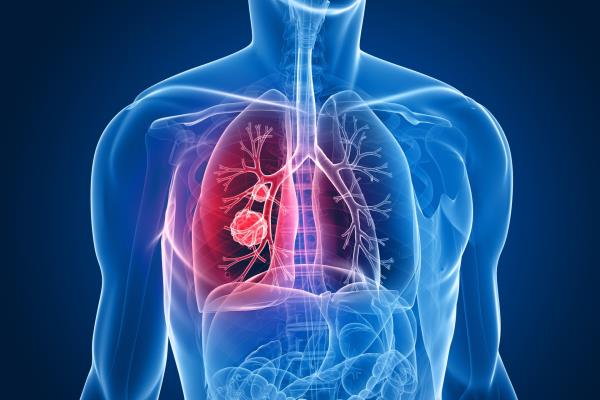Nuevos tratamientos mejoran a pacientes con cáncer de pulmón