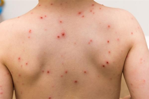 Alertan de los primeros casos de varicela en la región