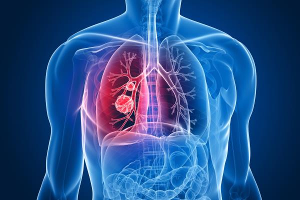 Cáncer de pulmón será en 2020 primera causa de muerte entre mexicanos