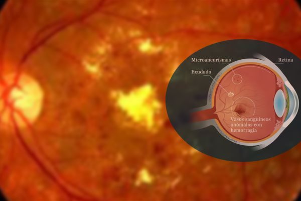 Retinopatía diabética, de las principales causas de ceguera en México