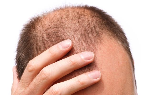 La mitad de hombres jóvenes pierden cabello por estrés y hormonas