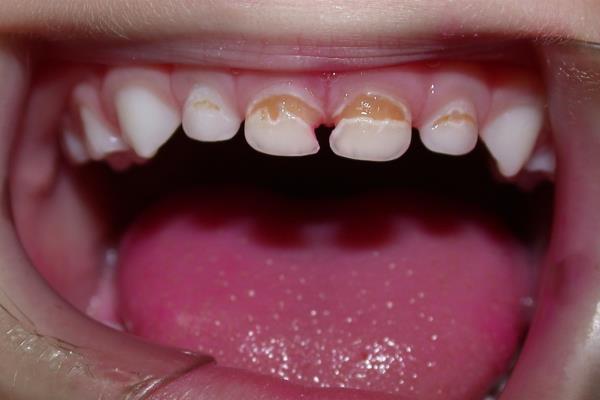 Aumentan casos de cáncer bucal y pérdida de dientes en niños