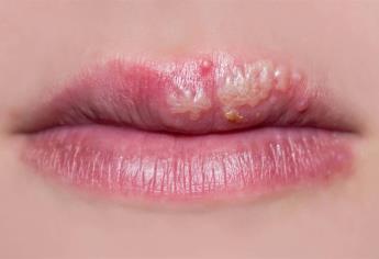 Advierten que herpes labial puede contagiarse a genitales