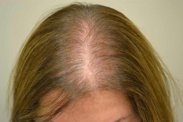 Estrés y problemas hormonales, causas de caída de cabello en mujeres