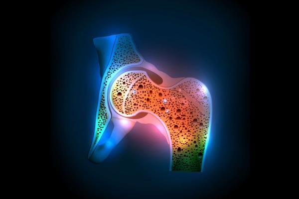 Osteoporosis, problema de salud pública en México