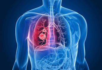 80% de casos de cáncer del pulmón se diagnostican en etapa avanzada