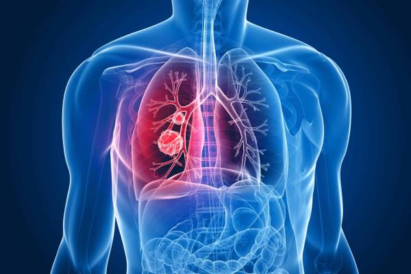 80% de casos de cáncer del pulmón se diagnostican en etapa avanzada