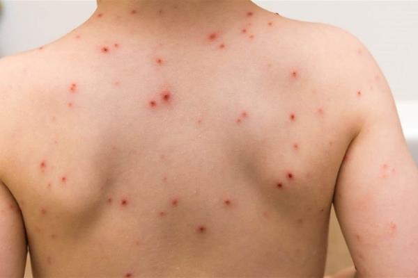 Llaman a estar alertas por el registro de casos de varicela