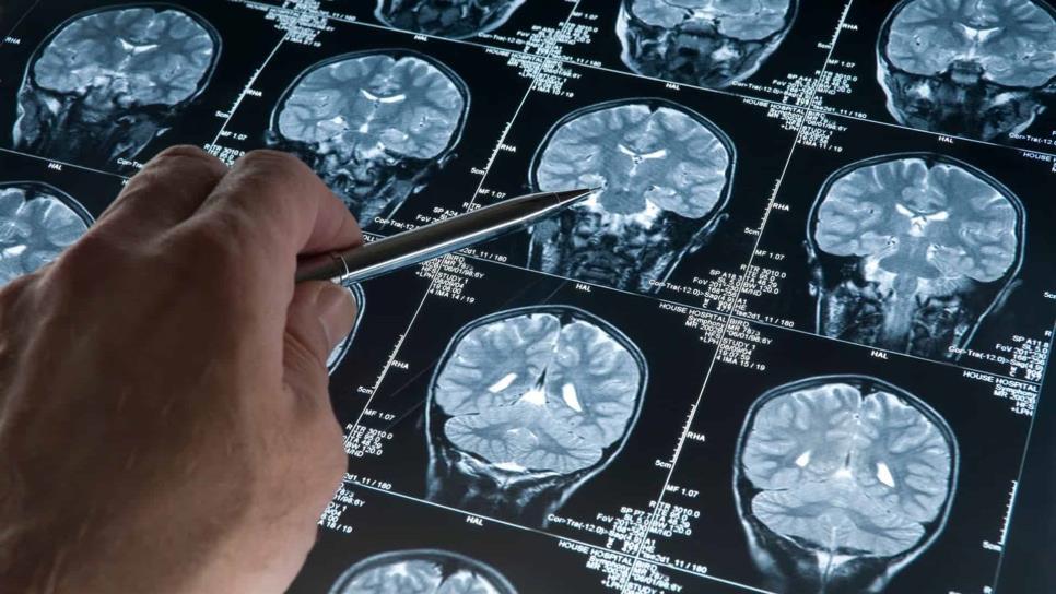 Desarrollan proteína para tratamiento de Alzheimer