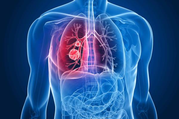 Cáncer de pulmón, uno de los más frecuentes entre los varones