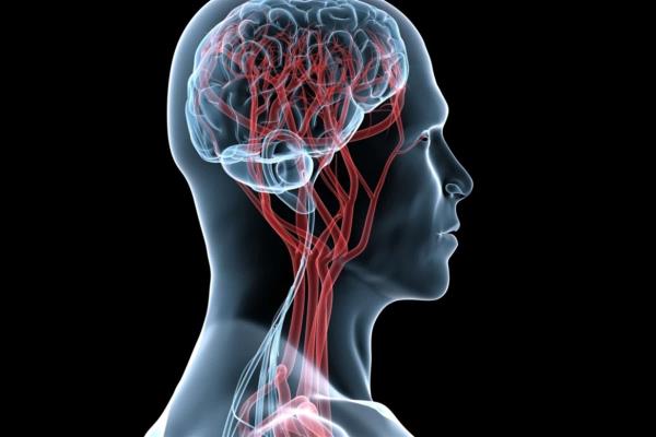 Antecedente de derrame cerebral aumenta riesgo de complicación cardíaca