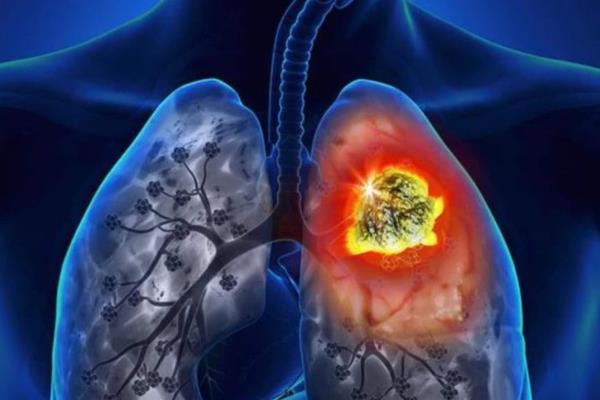 Esperan inmunoterapia contra cáncer de pulmón para 2020