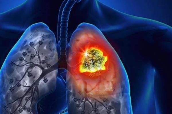 Presentan medicinas para tratamiento de pacientes con cáncer de pulmón