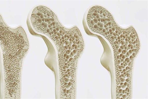 Fractura por osteoporosis, aumenta mortalidad en México