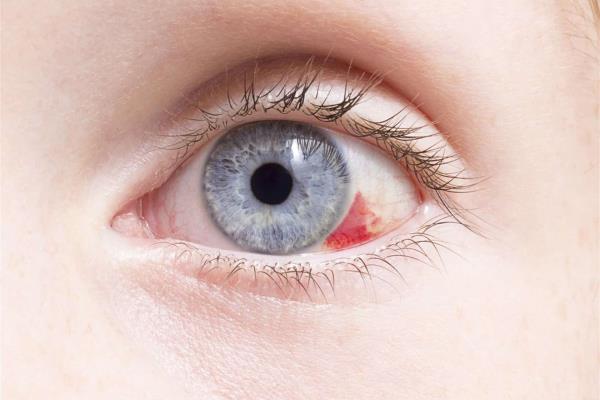 Descartan que derrame ocular cause problemas de visión
