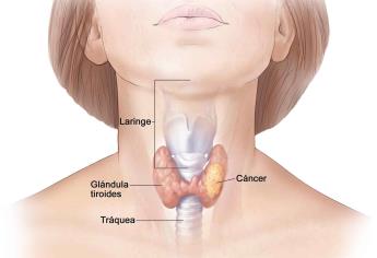 Enfermedades tiroideas afectan más a mujeres que a hombres
