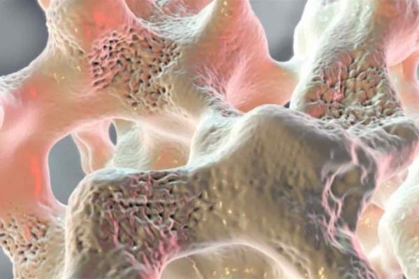 Osteoporosis costaría al país más de 6 mil mdp en 2020, alerta experta
