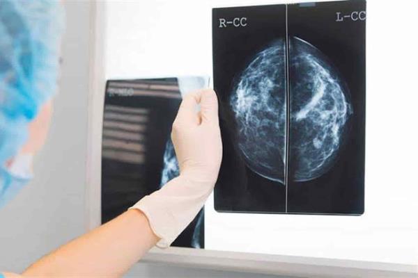 Encuentran proteína que suprime metástasis de cáncer de mama