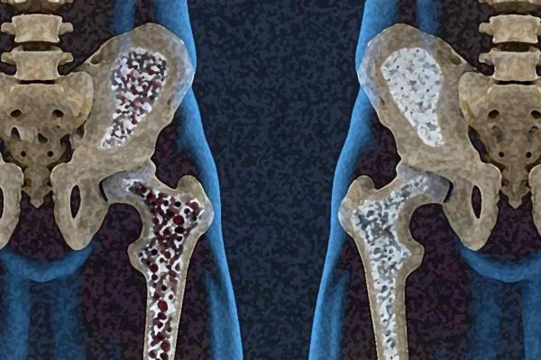 Esto es lo que debes saber acerca de la osteoporosis