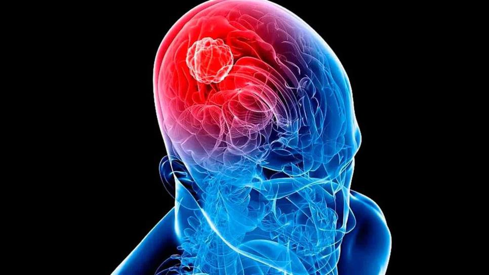 Esto es lo que debes saber de los tumores cerebrales Esto es lo que debes saber de los tumores cerebrales