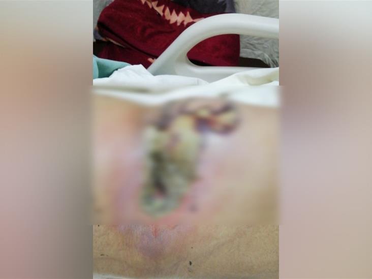 Marina busca donadores de sangre, le picó una araña violinista Marina busca donadores de sangre, le picó una araña violinista