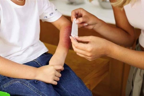 Shriners implementará programa de prevención de quemaduras en el hogar