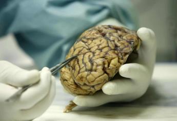 Identificadas 75 regiones del genoma asociadas a la enfermedad de Alzheimer