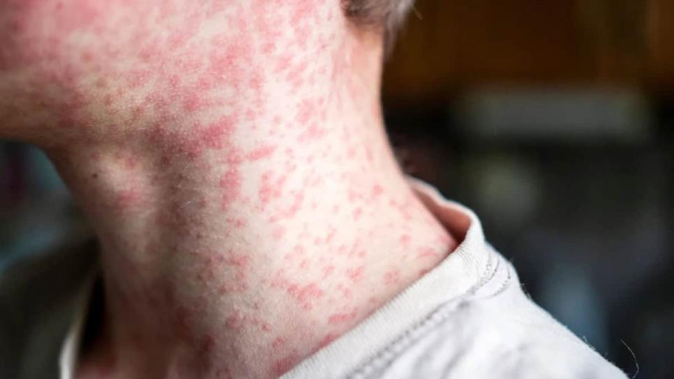 Sarampión en México: ¿Quiénes deben vacunarse para evitar el virus?