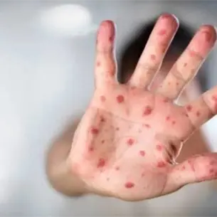 Sarampión en Torreón: bebé y joven dan positivo; establecen cerco sanitario en Mayrán